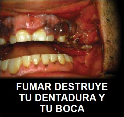 Ecuador 2012 Health Effects mouth - mouth cancer, gross